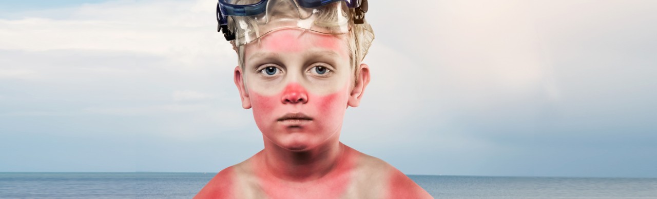 boy with sunburn